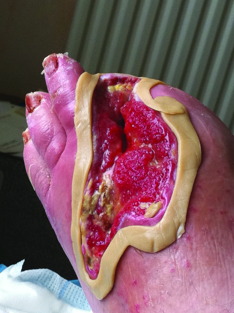 Managing patients with fungating malignant wounds Nursing Times