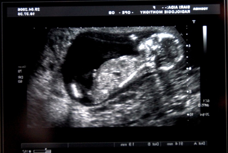 High levels of infection among caesarean births Nursing Times