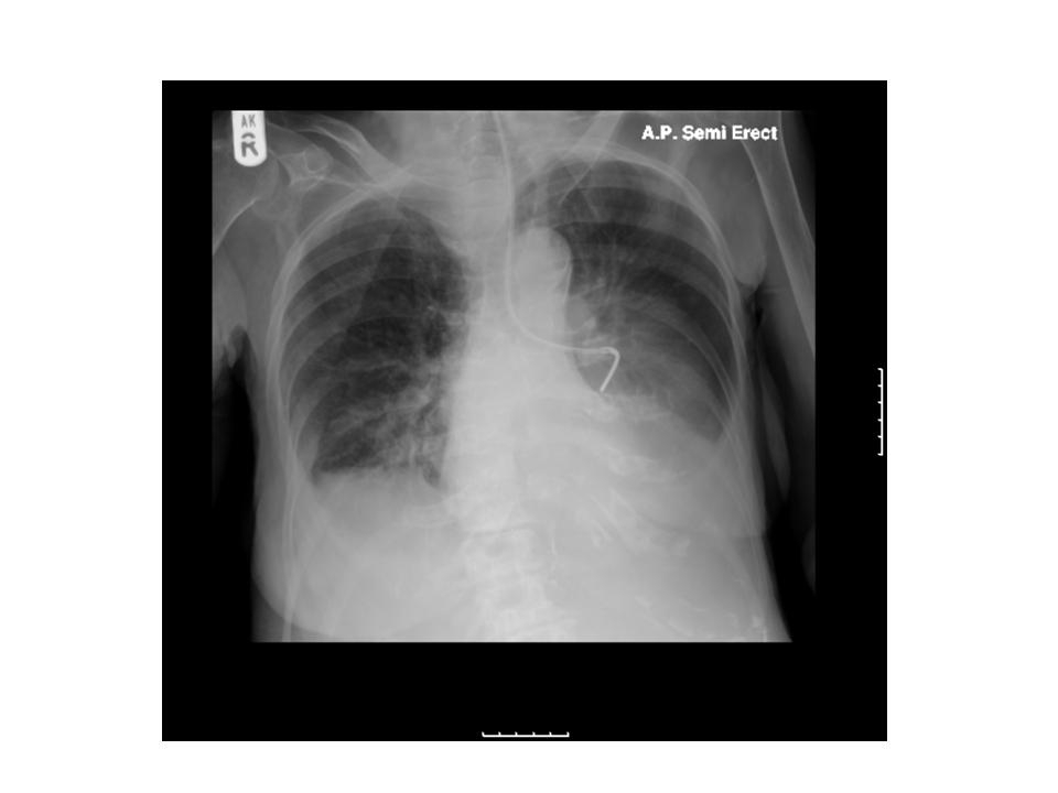 Safe removal of knotted nasogastric tubes Nursing Times