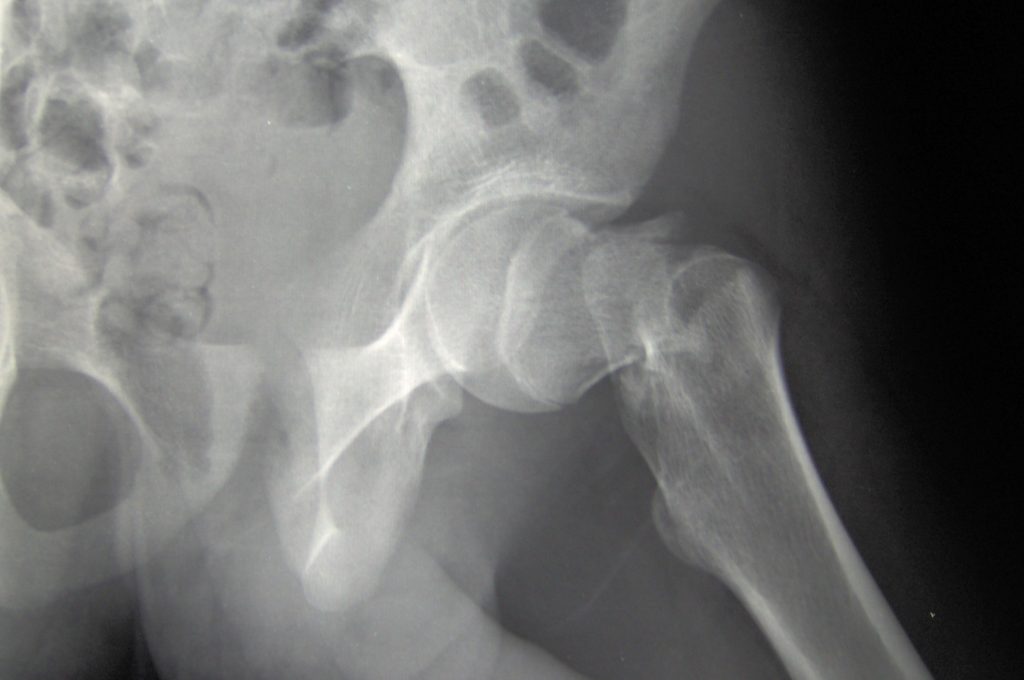 Bone mineral density 'only' factor to increase fracture risk Nursing
