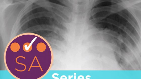 How to interpret chest radiographs (X-rays): a systematic approach - Vimarsana News